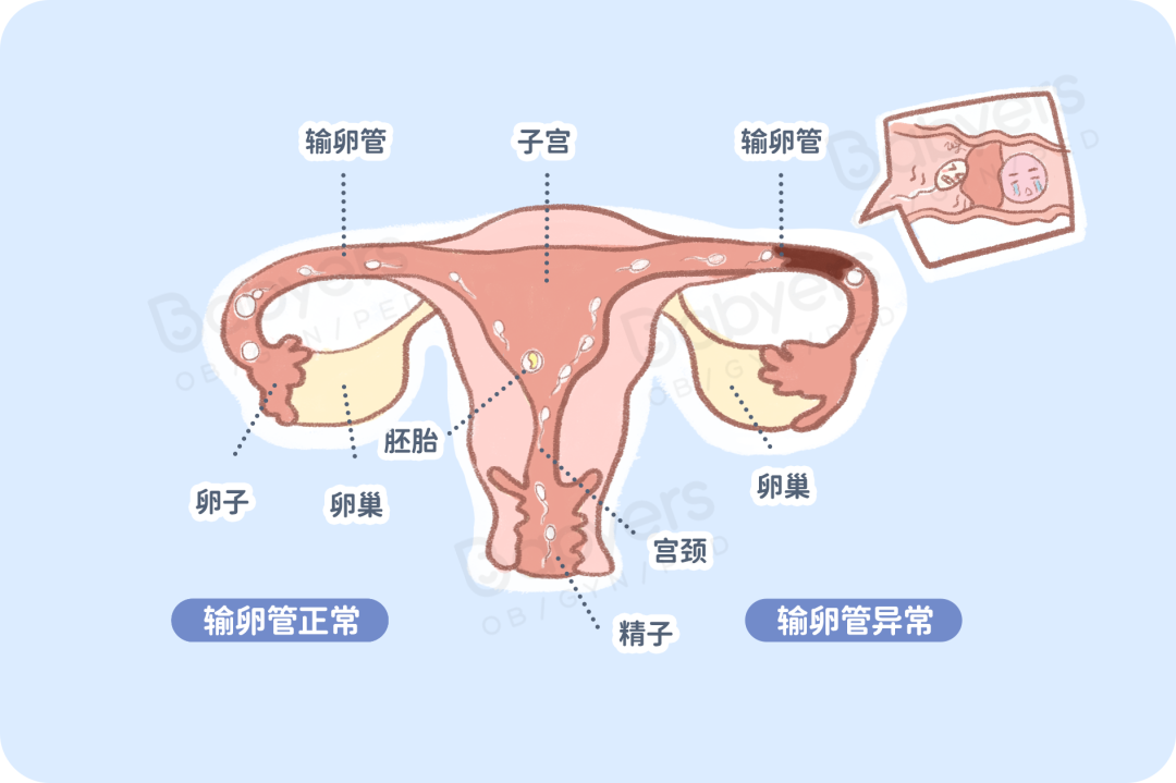 输卵管堵塞会造成什么后果？