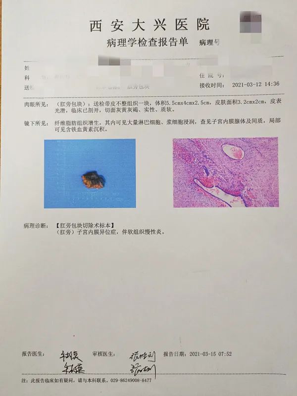 子宫内膜异位住进肛肠科！是不是搞错了？