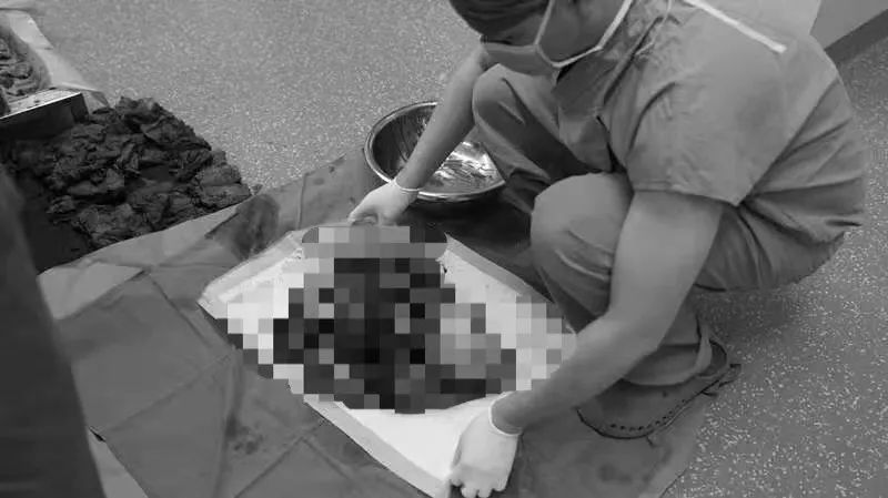 15斤！面对这个重量，从医二十年的医生都惊呆了