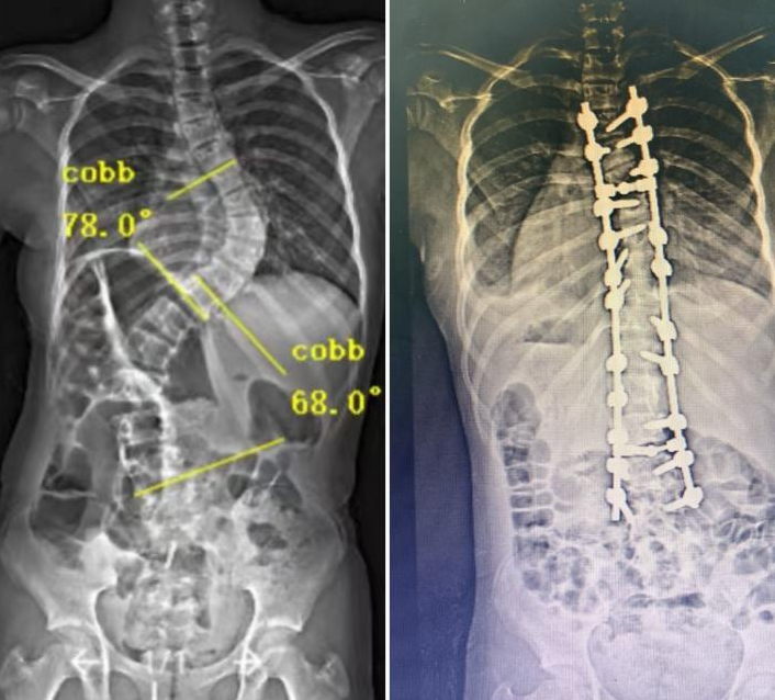 3 年脊柱侧弯折磨，14 岁少女终于挺直了腰