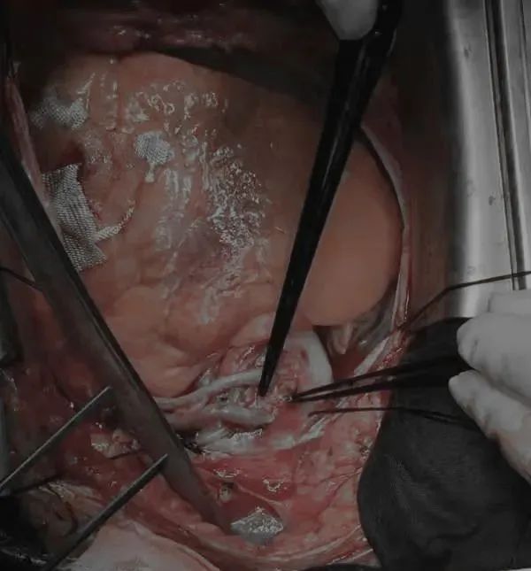 赤峰市宁城县中心医院心胸介入血管外科成功完成一例非体外循环下冠状动脉旁路移植术