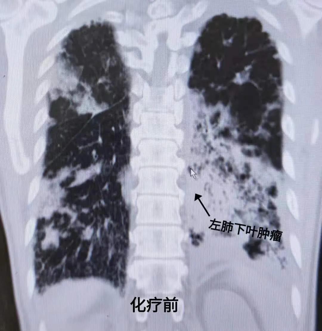 肺癌胸膜转移伴双肺炎如何制定安全有效的治疗方案