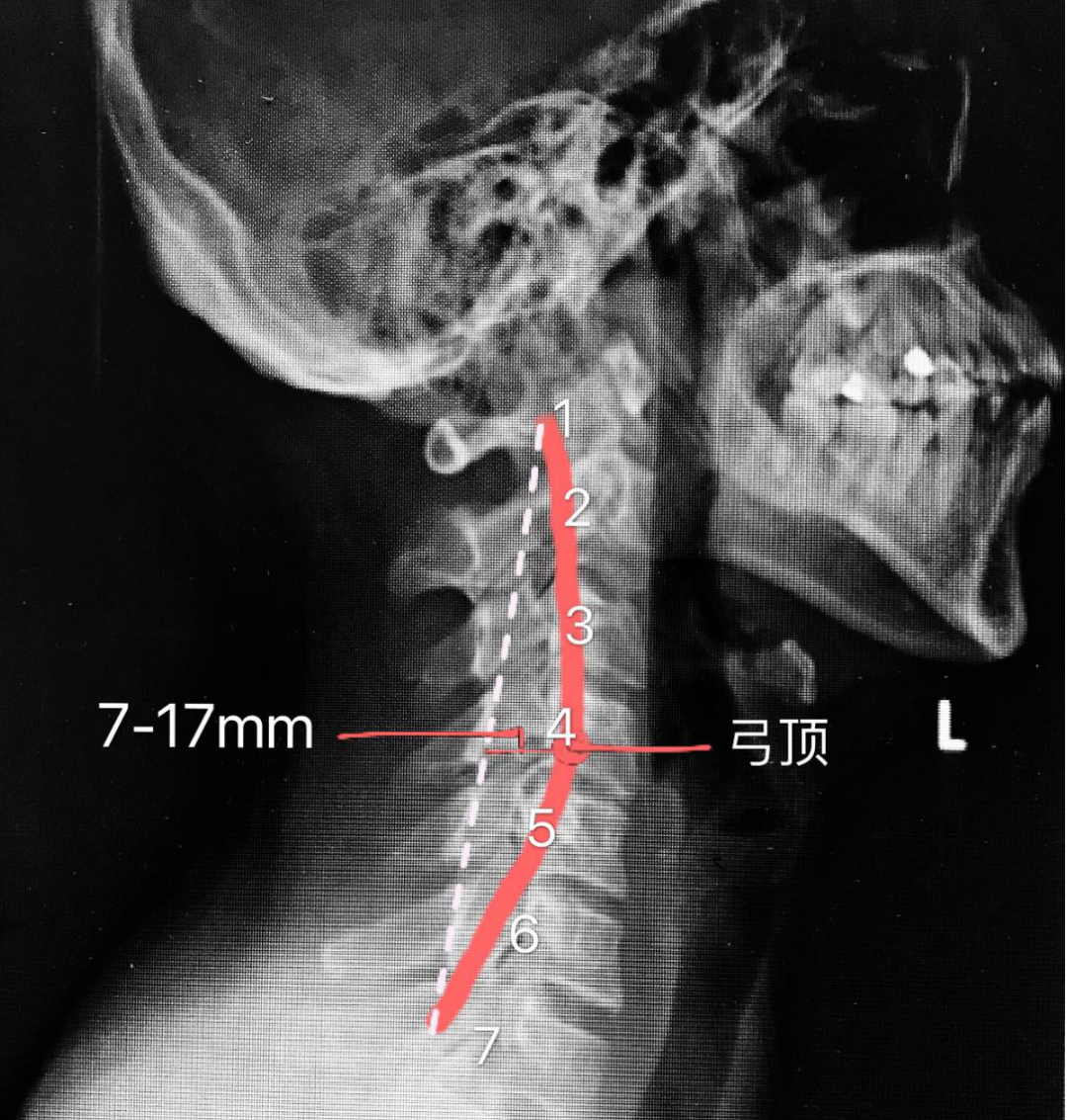 颈椎x光片,正常的颈椎光片图,腰椎光片_大山谷图库