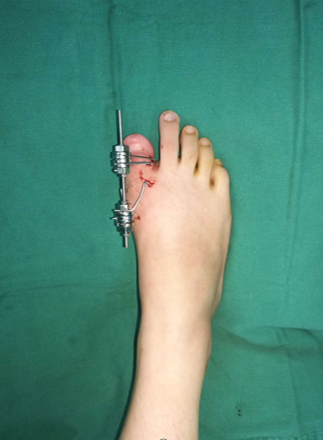 神奇！18 岁女孩面临截趾，医生一波操作，让趾骨缩短再延长，她的脚趾又「复原」了～