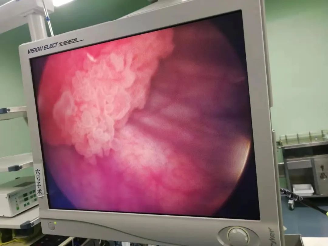 跨越微创手术「雷区」，烟台海港医院泌尿外科实施侧壁膀胱肿瘤整块剜除术