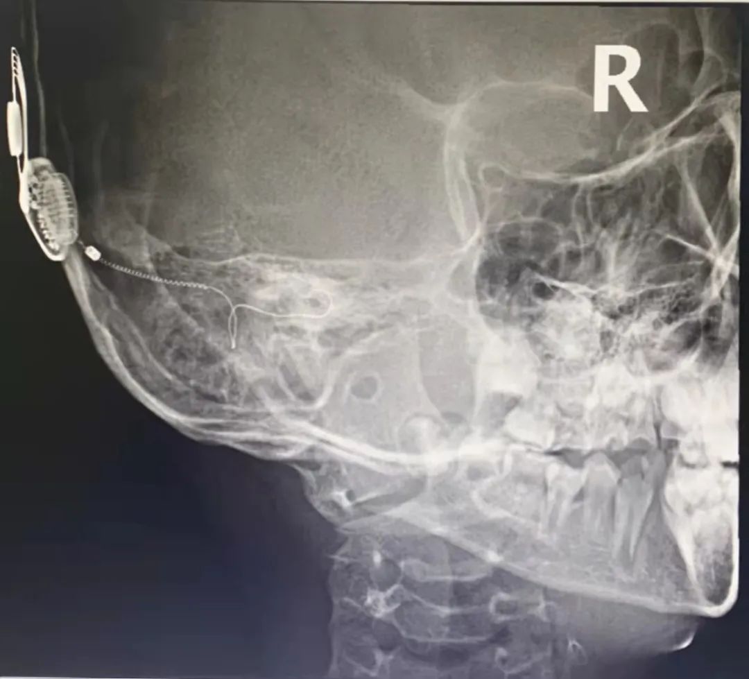 重获「新声」,南方医科大学顺德医院首例人工耳蜗成功植入