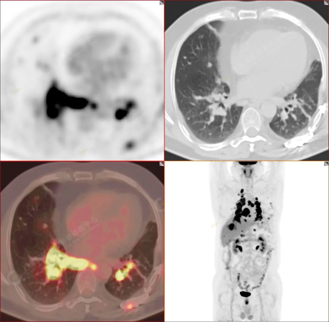 高尚病例：PET/CT-MR 诊断结节病双肺及全身多发淋巴结广泛累及 1 例