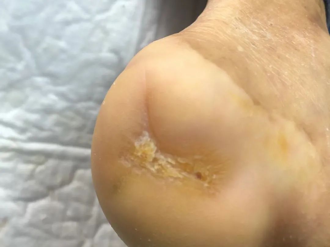 陶树贵院长通过线上诊疗成功为患者保肢