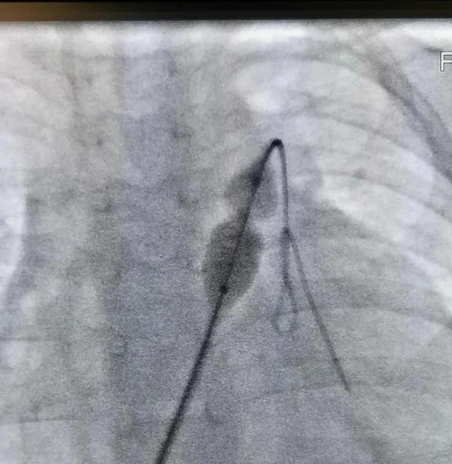 肺动脉瓣最窄 1.8 毫米，先心宝宝重生，这场手术值得点赞
