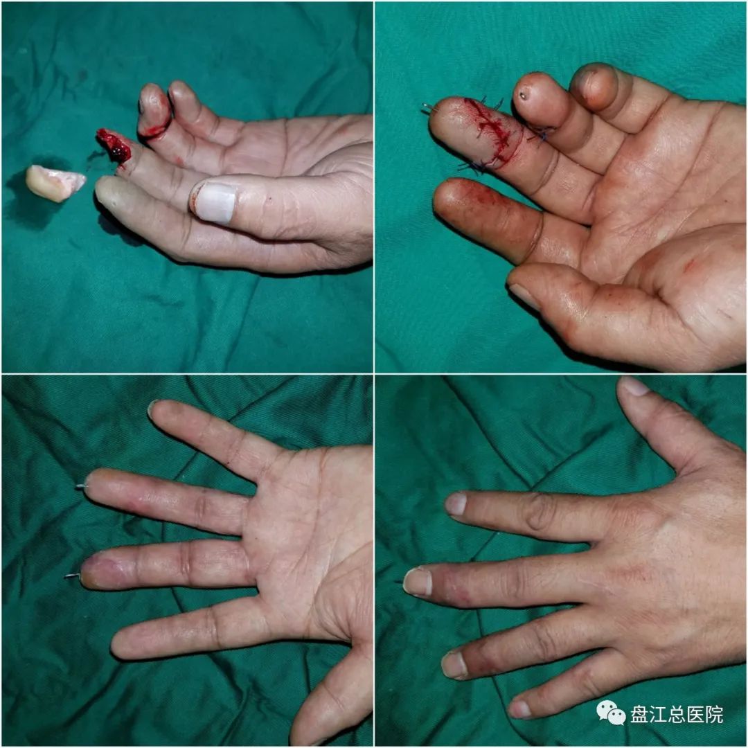 「不抛弃、不放弃」——记盘江总医院奋战在手足显微外科领域的「斗士」范辉