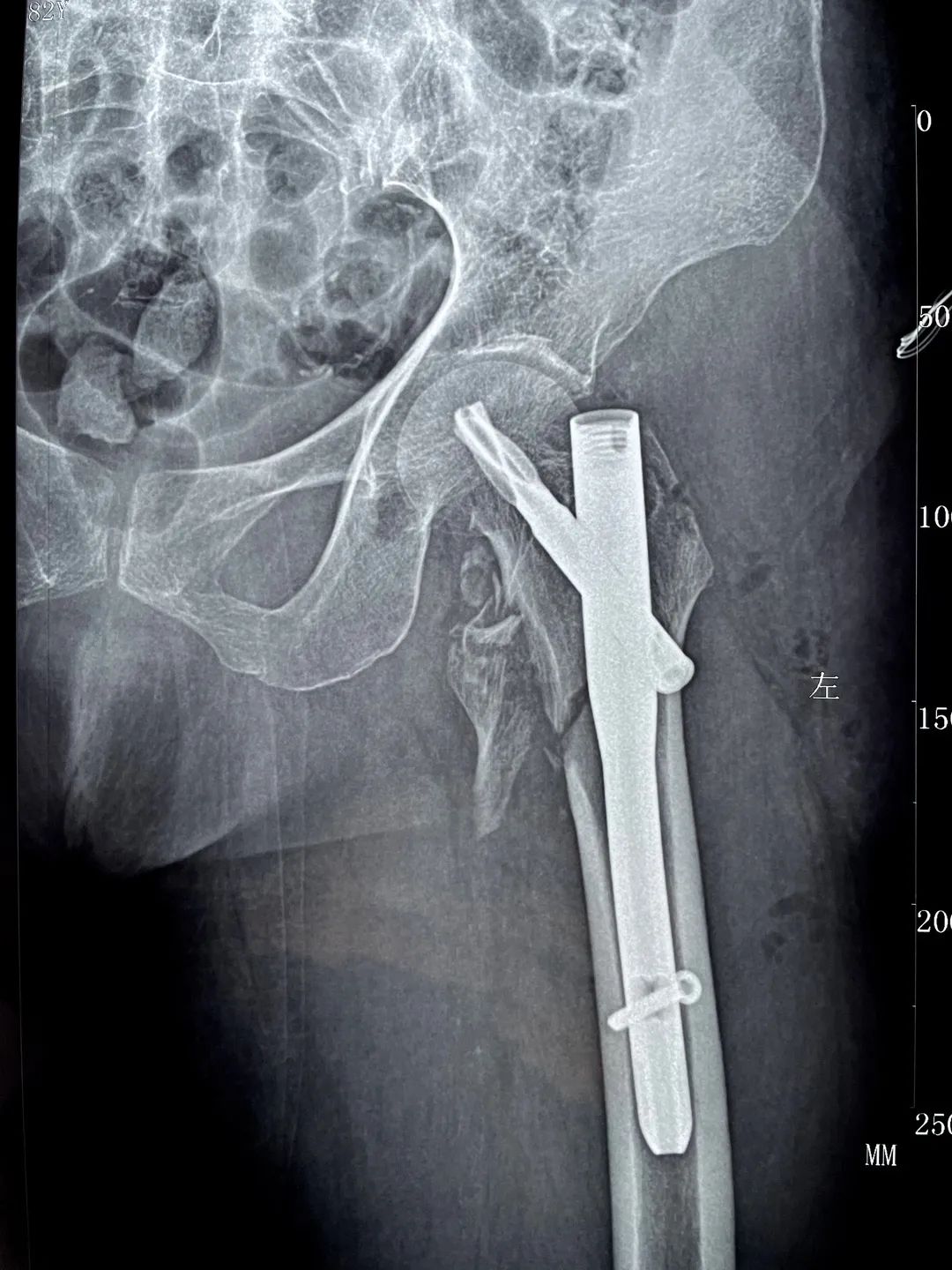 长春骨伤医院顺利为 84 岁高龄老人完成「左侧股骨粗隆间骨折闭合复位内固定手术」