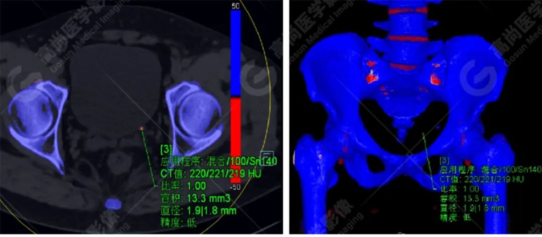 高尚病例:双能量 CT 成像分析泌尿系结石成分