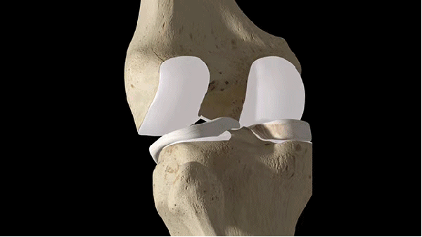 北部宽仁医院为双膝重度关节炎患者成功置换关节