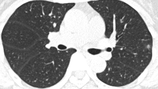 肺结节是「肺癌」？影像科专家：该病良恶难辨，别白挨一刀！