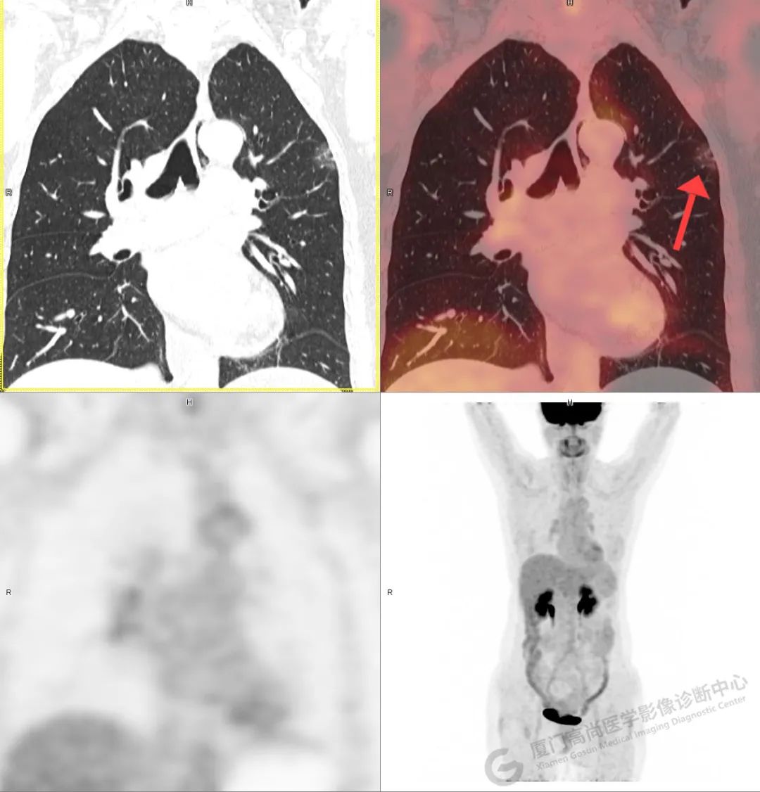 高尚病例：胸部 CT 检查在肺癌早筛中的应用