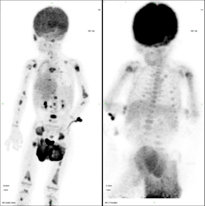 儿童淋巴瘤大查房——我们如何诊治一例同时伴有成熟标记和 MLL-AF9 的 B 淋巴母细胞淋巴瘤