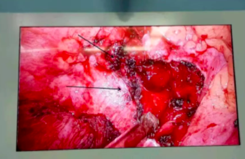 男子罹患巨大纵膈肿瘤！深圳市龙岗区人民医院骨科胸外科 MDT 团队 2 次手术祛除疾患