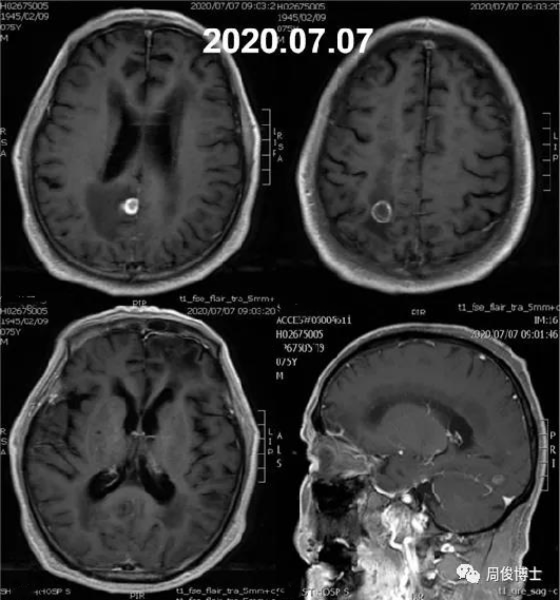 周俊主任：肺癌脑转移又发癫痫，75 岁老者如何闯过难关？