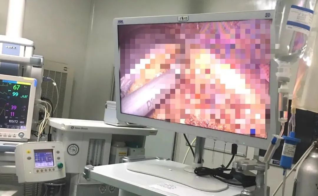 常德市第四人民医院成功开展首例全 3D 腹腔镜下肝叶切除术