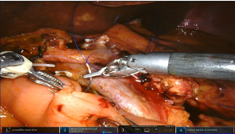 胰腺外科治疗进展：腹腔镜、机器人及开放手术