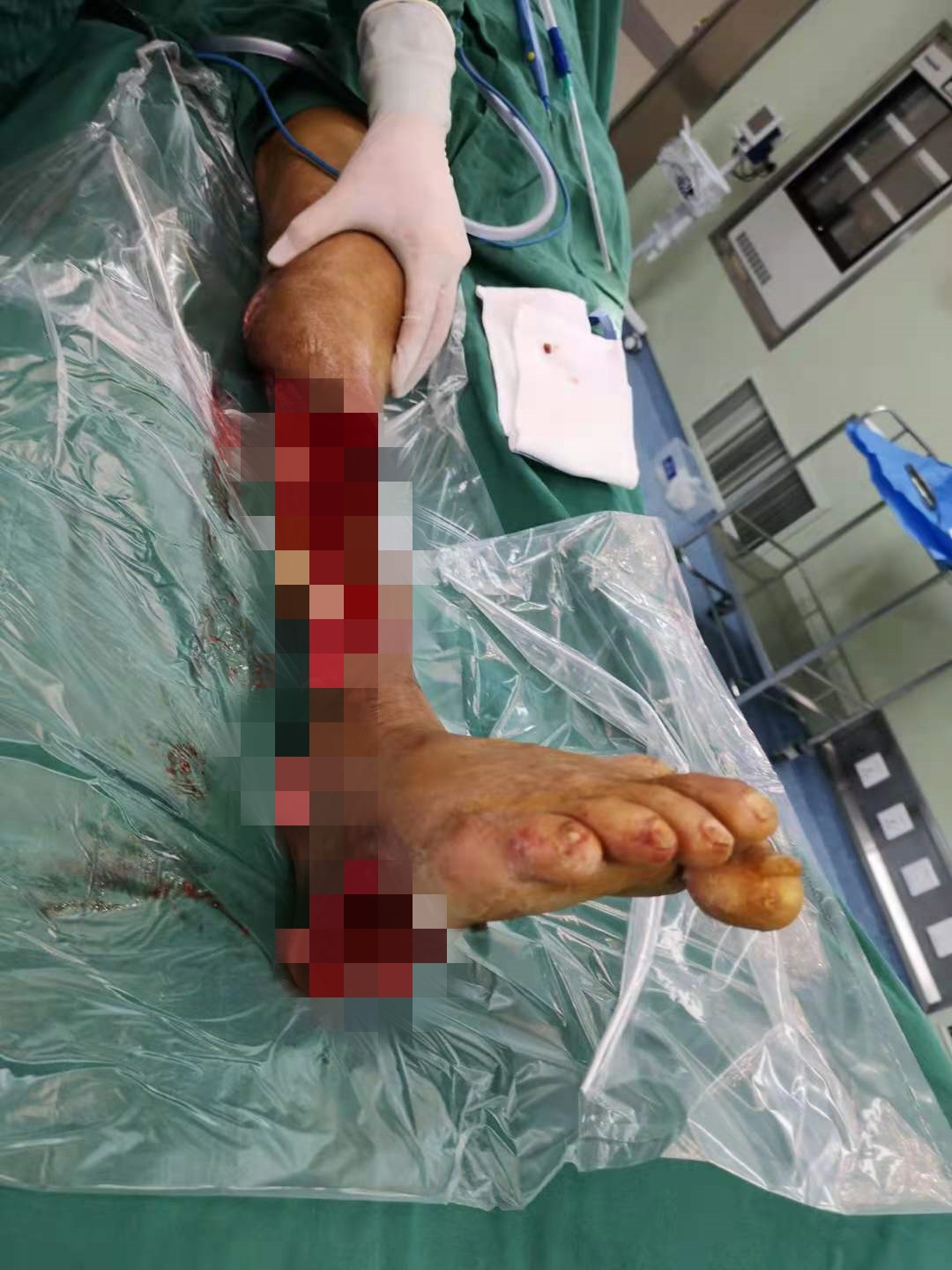 南昌大学第二附属医院杨立文教授团队为严重毁损伤患者保住下肢