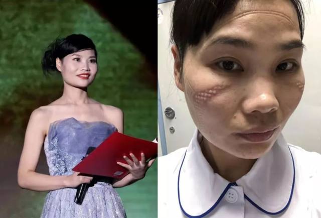 武汉抗疫前线护士摘下口罩后的照片曝光，太让人心疼了！