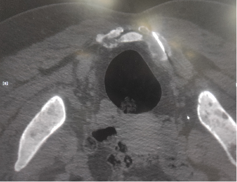 影像诊疗中心完成 1 例高难度肝包膜下转移瘤微波消融治疗