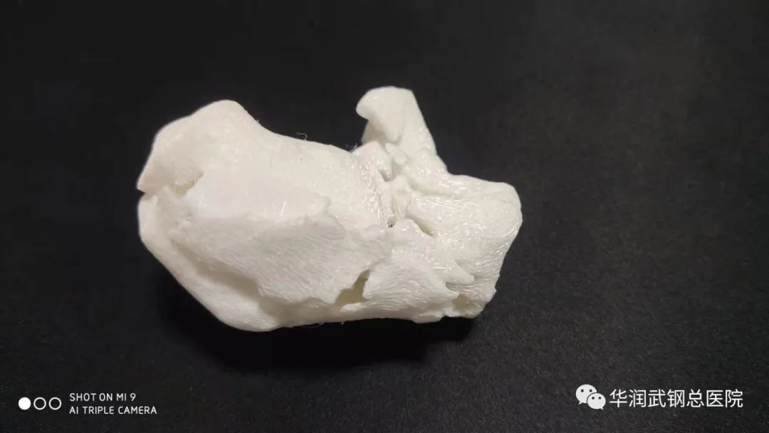华润武钢总医院骨三科巧用 3D 打印技术，微创匠心解人忧