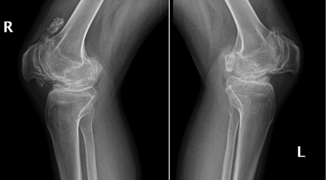 重庆北部宽仁医院：「不死的癌症」强直性脊柱炎，究竟有多痛？