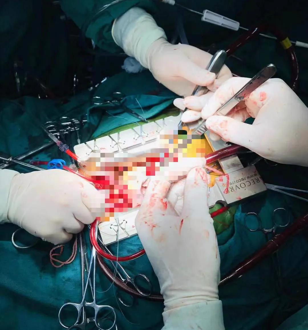 南京江北人民医院万峰心脏团队成功完成一例左心房巨大粘液瘤摘除