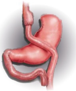 图解操作步骤：一文读懂各类对「胃」下手的外科减肥法