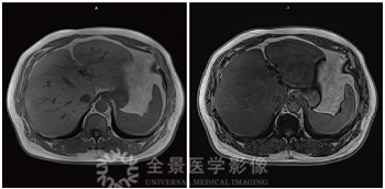 上海全景医学影像诊断中心告诉轻度脂肪肝的你：1 个坏消息，1 个好消息