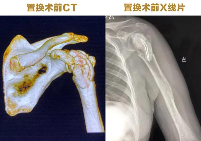 西安大兴医院骨科完成西北罕有复杂翻修反肩关节置换术