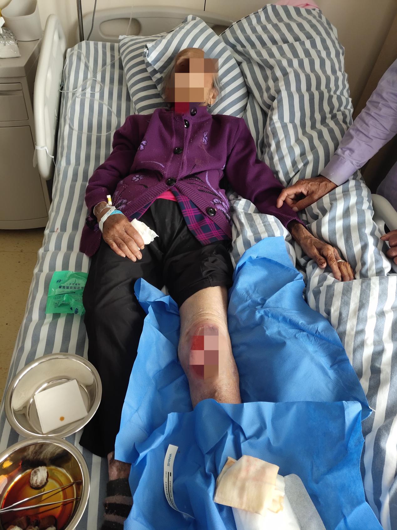 南昌大学第二附属医院整形美容科杨立文教授团队成功为 105 岁患者开展带蒂皮瓣移植术