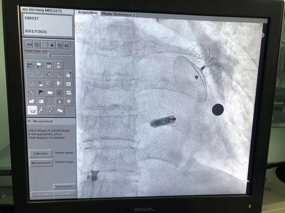 深圳龙岗区首例：87 岁老人成功植入无导线起搏器