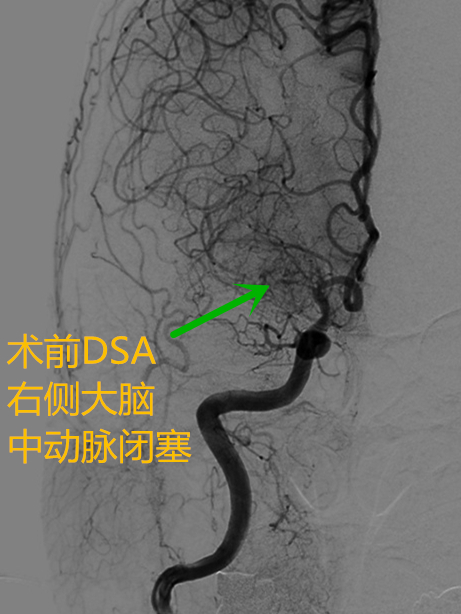 深圳市龙岗区人民医院首例大脑中动脉慢性闭塞介入开通术