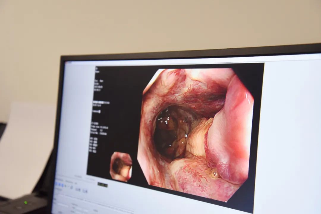 便血 53 年的原因找到了,成都京东方医院治疗一例罕见病