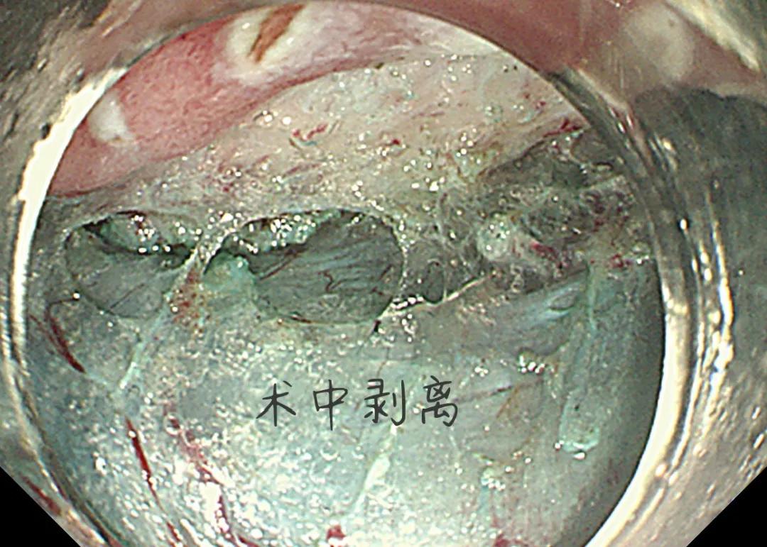 岳池县人民医院成功开展县域首例经内镜下胃早癌切除术