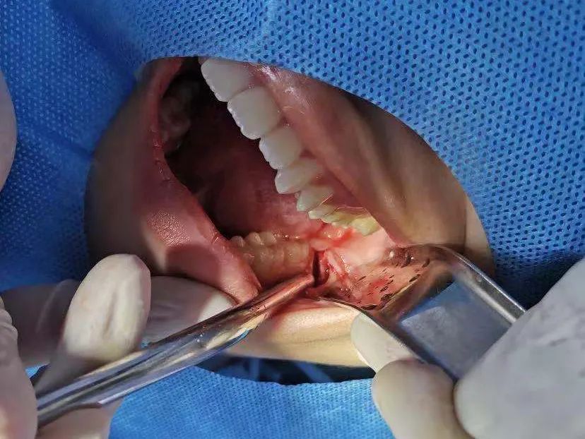 拔智齿 = 小手术！怎么判断智齿是否需要拔除呢？