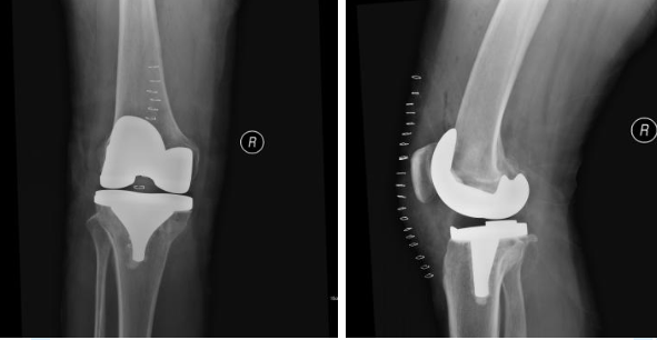 膝关节置换术的病例分享