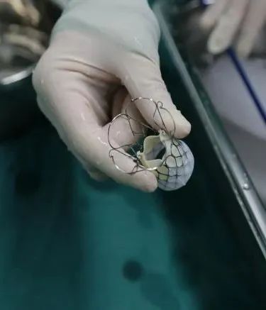 合肥京东方医院首例 TAVR 手术成功,心脏主动脉瓣置换现已进入「介入换新」时代