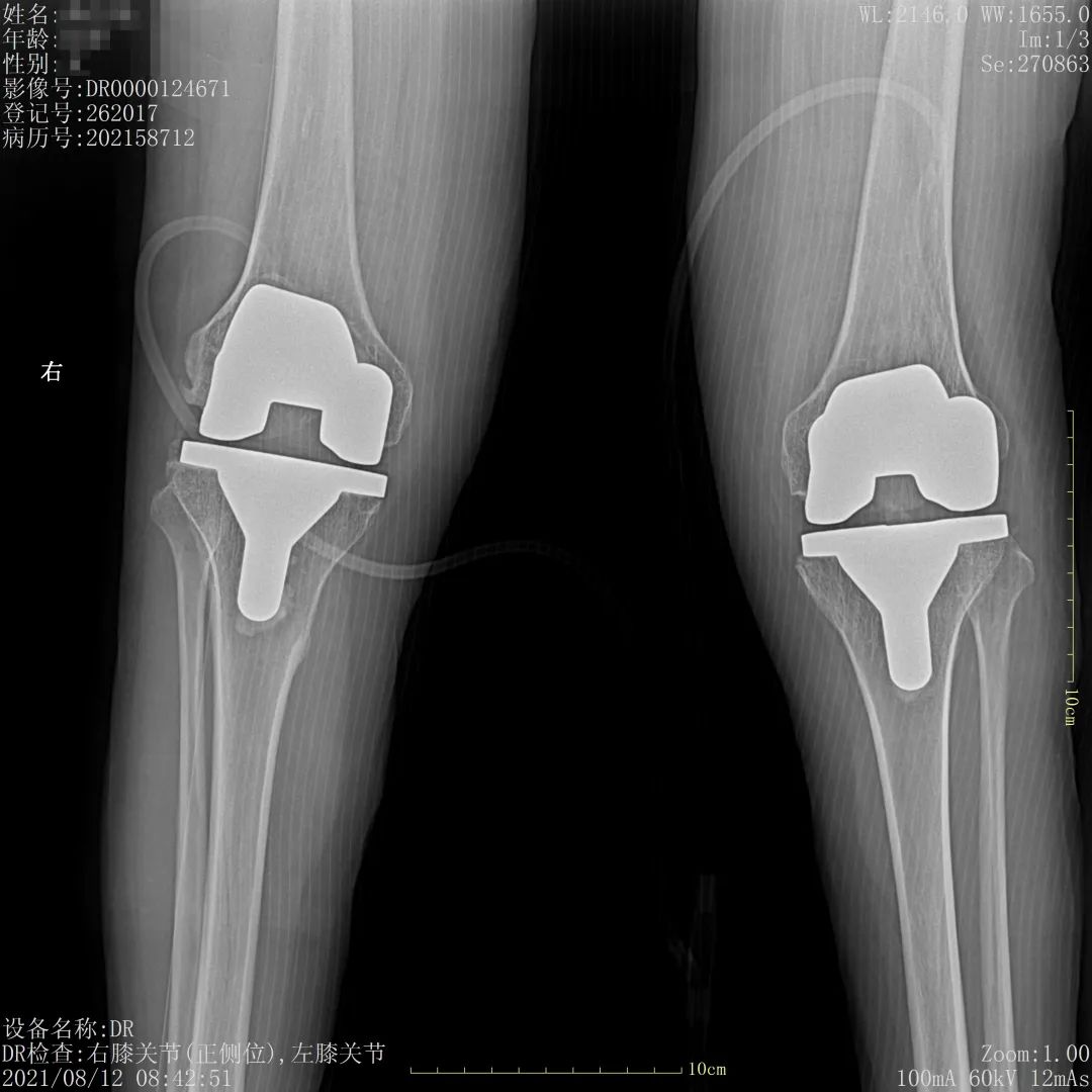 长春骨伤医院：人工膝关节表面置换术，为患者赶走疼痛