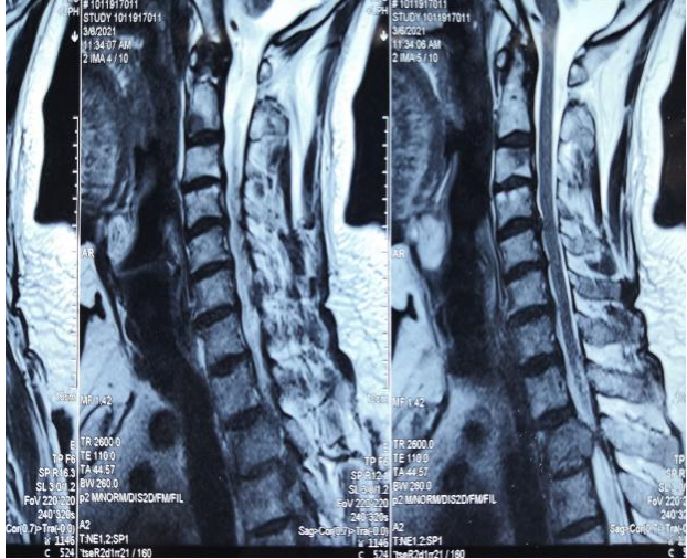 肩膀疼痛竟是肿瘤转移，瘤子侵占胸椎椎管 90%，他要怎么办？
