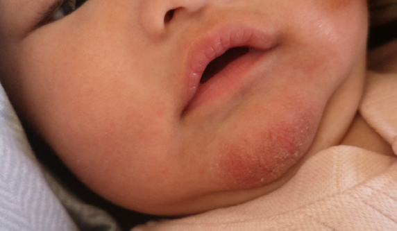 「湿疹宝宝」的润肤和居家护理，宝妈做对了吗？