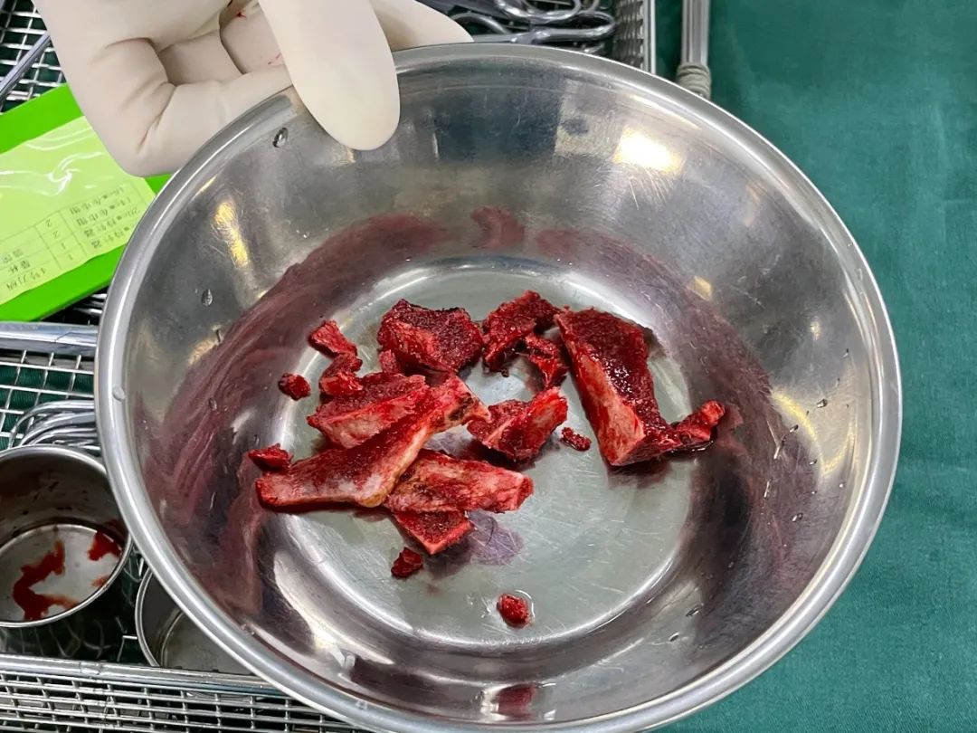 捐骨救子,母亲为他续写生命传奇