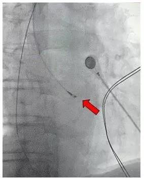83 岁老奶奶成为潍坊市首例希氏束心脏起搏手术受益者