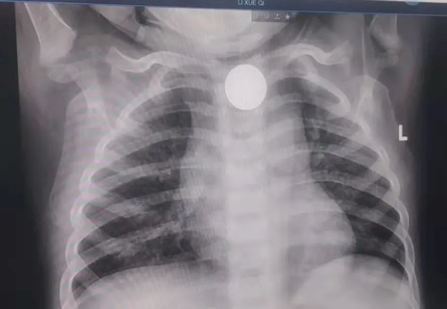 延大附院儿科三病区成功开展小儿胃镜检查及镜下治疗