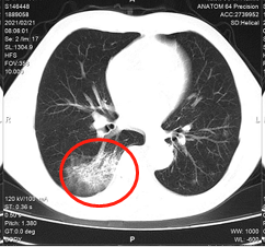 北京大学深圳医院：「我，肺癌晚期，没想到肿瘤竟然消失了」