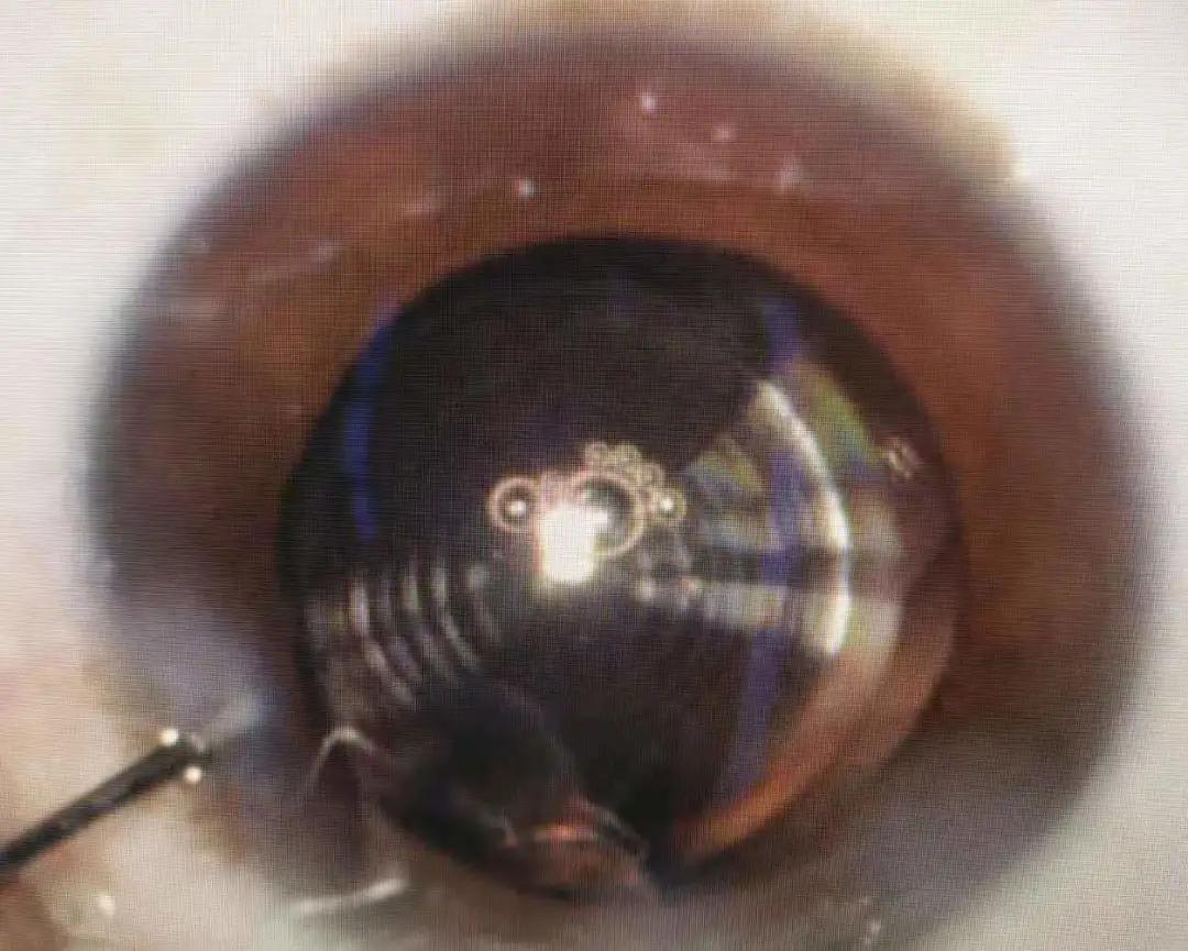 华润武钢总医院眼科成功实施首例连续视程人工晶体植入术