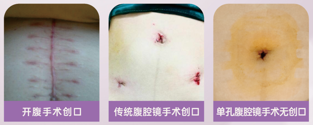 震惊！医生从她的肚子里掏出长达 1.6 米的子宫肌瘤